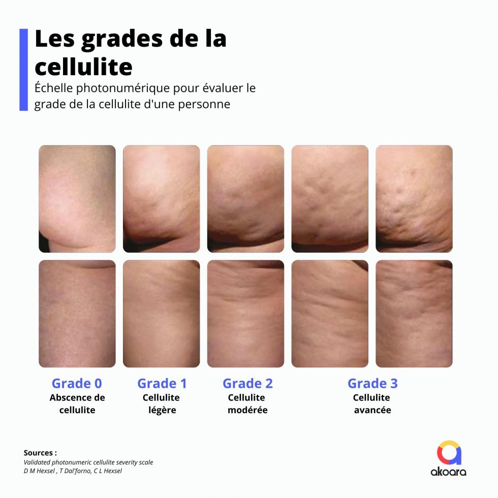 Cellutate Cellulite vs Lipœdème : quelles différences ? - Diététicienne du Lipoedème
